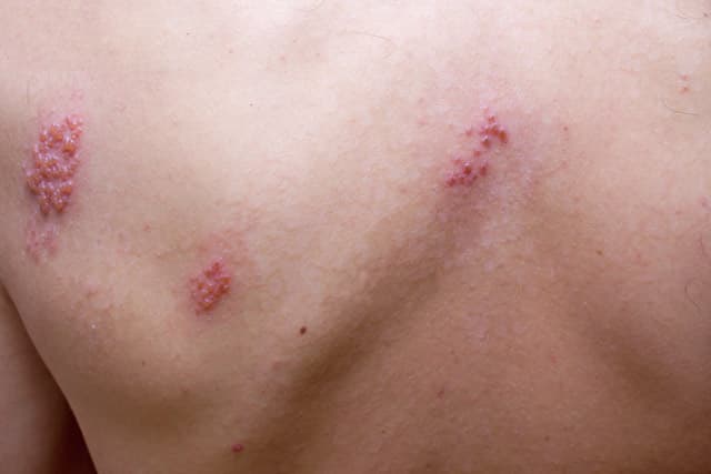 example of shingles